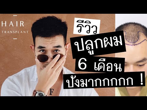 รีวิว ปลูกผม 6 เดือน ... ปังมากกกกกกกกกก //FRANKPHAIBUL