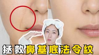 法令紋再也不用煩惱了！改善中臉下垂型｜鼻基底凹陷型法令紋