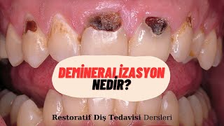 1-Demineralizasyon Nedir? DUS'taki önemi - DUS Restoratif Diş Tedavisi Dersleri Resimi