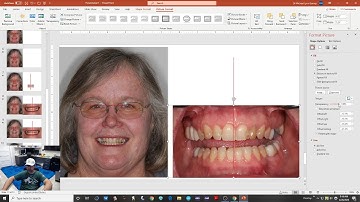 PowerPoint - Smile Design Part 2 - Loading all the photos