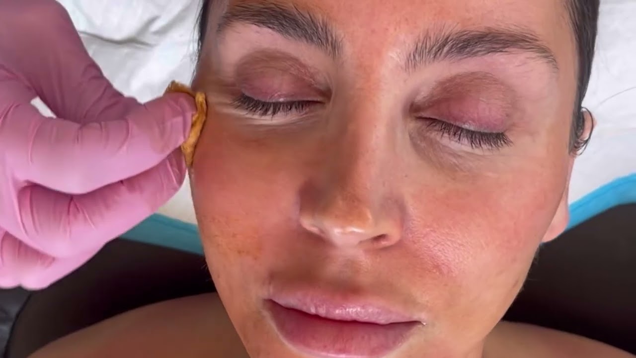 Medical Grade Skin Peel | Application | Results