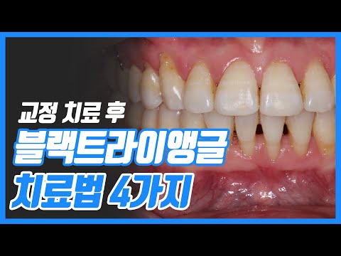 구내염비타민