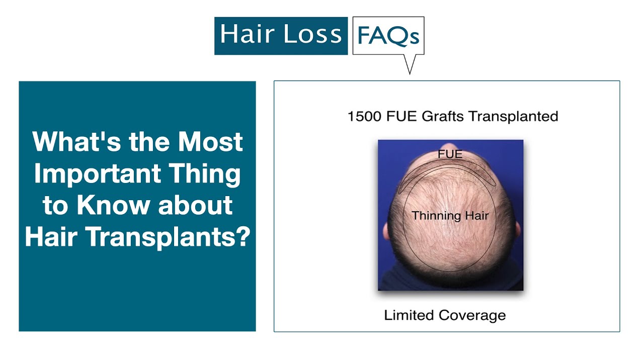 What is the Most Important Thing to Know about Hair Transplants?