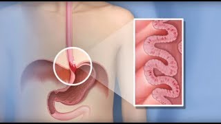 Barrett's Study Results-Mayo Clinic