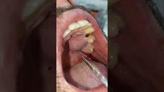 Palatal Abscess Incision and Drainage - تصريف خراج من سقف الفم