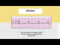 Learning To Read EKG Rhythms