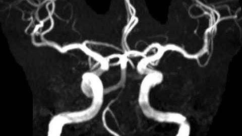 Persistent Trigeminal Artery
