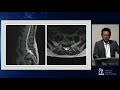 Surgical Treatment of Isthmic Spondylolisthesis with Single Position MIS - Sean Keem, MD, MBA