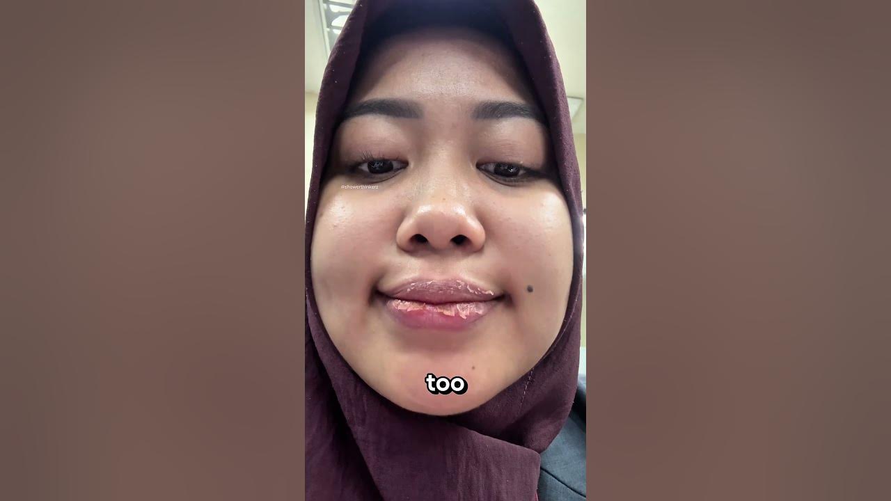 Never Peel Your Dry Lips‼️😱