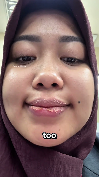 Jangan Pernah Mengelupas Bibir Kering Anda‼️😱