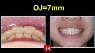 CC332. Simplify CII Correction Part 1