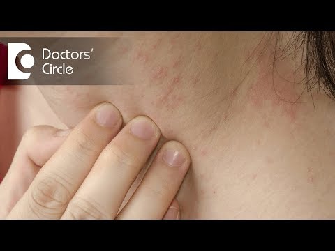 Video: Scabies Bites: Bilder, Symtom Och Behandlingar