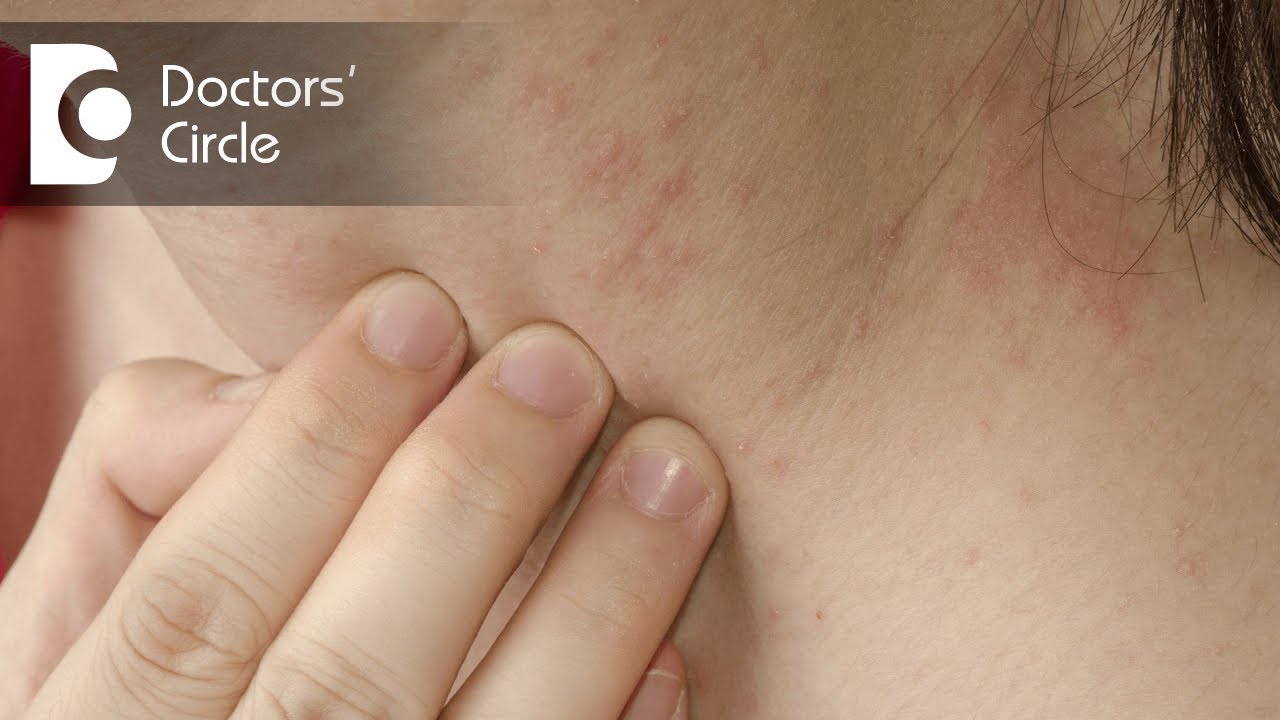 How To Identify Scabies Rash Its Management Dr Sudheendra