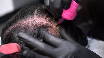 Scalp Micropigmentation for women to add density!