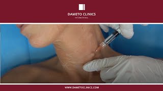 Profhilo BAP Neck injection technique by Dr. Gabriel Siquier