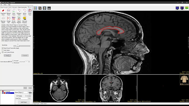 Analyze 14.0 - Segment: Smart Trace