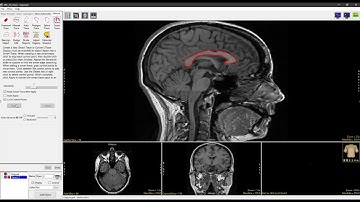 Analyze 14.0 - Segment: Smart Trace