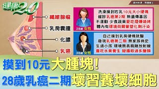 摸到10元大腫塊28歲女乳癌二期 壞習養壞細胞 健康2.0