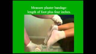 Casting A Foot in 3 Minutes - custom foot orthotics
