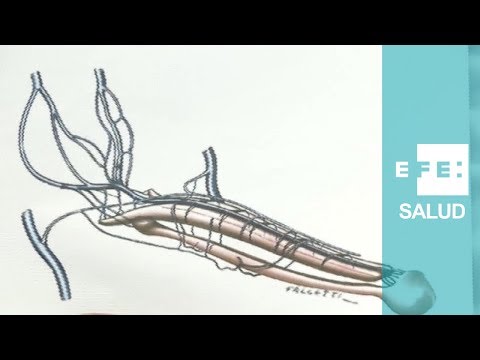 El del pene eje varicosa en vena