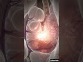 Gout Flare