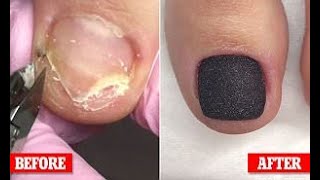 Most Satisfying Pedicure and Ingrown Nail Treatment #3