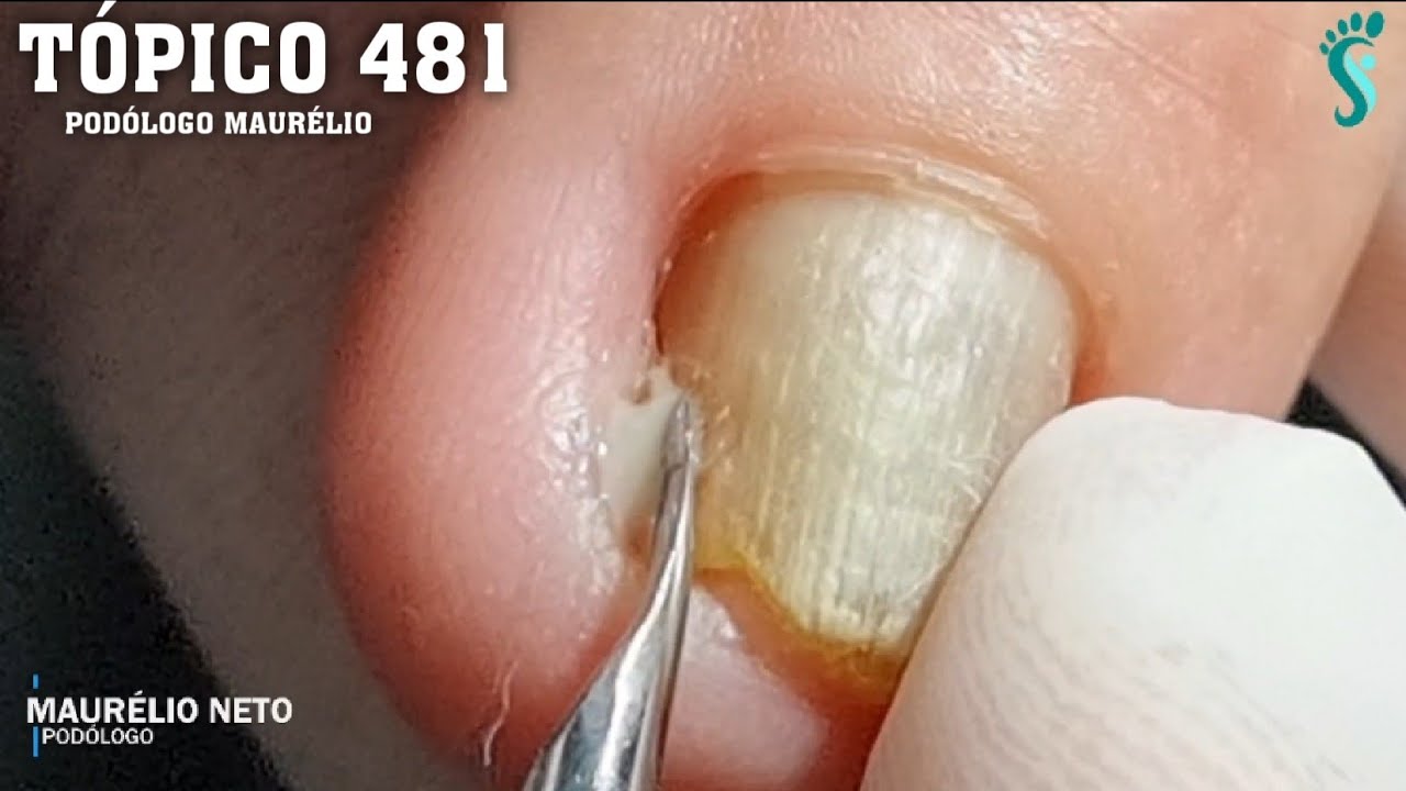 DEDO DA MÃO COM PUS !!