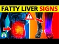 ⚡ Top 10 Signs and Symptoms of Fatty Liver You MUST AVOID