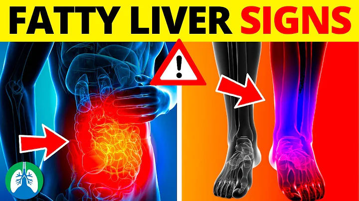 ⚡ Top 10 Signs and Symptoms of Fatty Liver You MUST AVOID - DayDayNews