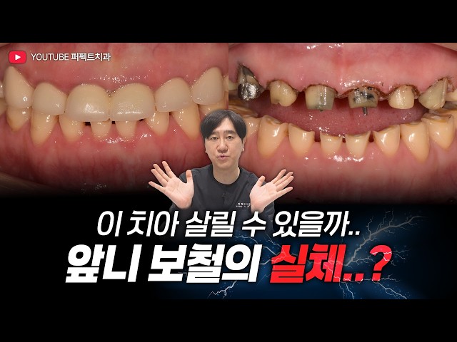크라운 벗겼더니… 심각한 신경치료 한 치아 (feat.부식치아 전악보철)