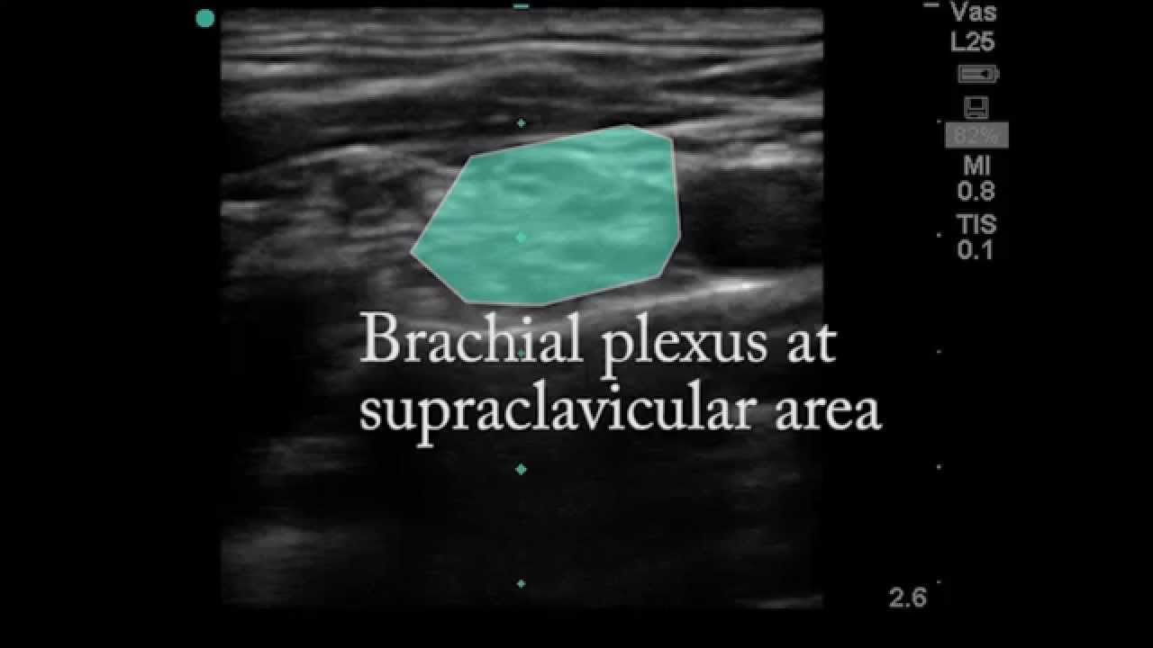 Interscalene anatomy scan with IJ - YouTube