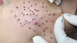 Make your day Relax with Relaxing LNS / blackheads removal/ blackheads animation blackheadsremoval