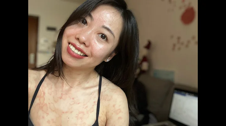 Pityriasis Rosea developing on my whole body