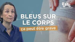Hématomes Bleus Sur Le Corps. Quand Faut-Il Sinquéter Et Comment Les Soigner ?