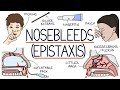 Understanding nosebleeds epistaxis