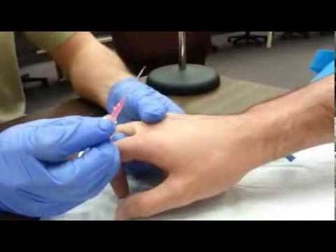 How to start an IV:  Dorsum of hand