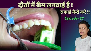 how to clean crown teeth at home |दाँतों में कैप लगवाई है,सफाई कैसे करें danto ki safai ।Episode 27