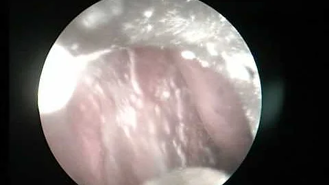 A cosa serve il Talcaggio pleurico?