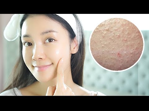 ENG) 좁쌀여드름! 스킨케어 이렇게 하세요 Skincare for Millet Seed Acne MSA | 뷰티클라우드 유나 UNA