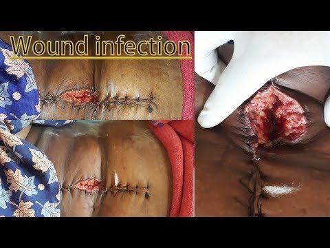 Wound infection - Surgical site infection