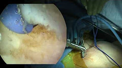 Arthroscopic Sternoclavicular Joint Resection | Sternoclavicular Joint Arthritis