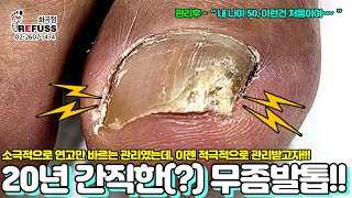 20년 간직한(?) 무좀발톱, 내성발톱!?? 소극적으로 연고만 바르다 이젠 제대로 관리하려 왔어요^^ #레푸스 #refuss #내성발톱 #무좀발톱 #발톱 #toenails