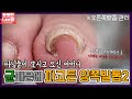 유쾌한 따님들이 모시고오신 어머니의 파고든발톱 (오른쪽발톱 관리) ingrown toenail / ingrowing nail - Fresh Foot