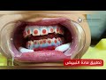 Laser teeth whitening (clinic) | (تبييض الأسنان الليزري (العيادة