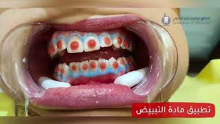 Laser teeth whitening (clinic) | (تبييض الأسنان الليزري (العيادة