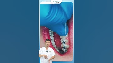 Chun Chuỗi Niềng Răng Có Tác Dụng Gì | Bác Sĩ Yên