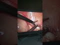 laparoscopic bloodless appendectomy