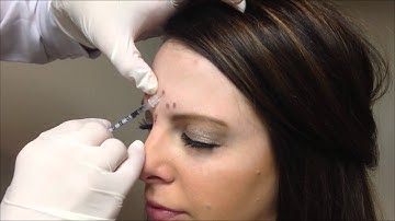Allergan Botox Injections