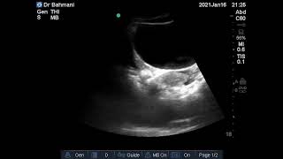 Case 88 : Normal ovaries with follicles and ruptured cyst