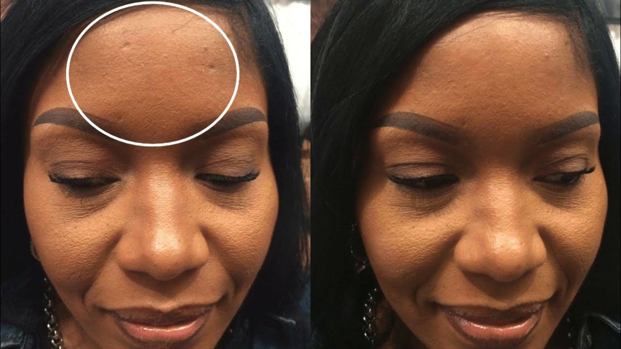 Dermaflage Scar Cover Makeup YouTube